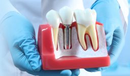 6 Foods to Eat and Foods to Avoid After Getting Dental Implants